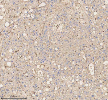 Immunohistochemical staining of Annexin using anti-Annexin antibody. Annexin was detected in a paraffin-embedded section of human liver cancer tissue. Heat mediated antigen retrieval was performed in EDTA buffer (pH 8.0, epitope retrieval solution). The tissue section was blocked with 10% goat serum. The tissue section was then incubated with 2 ug/ml rabbit anti-Annexin antibody overnight at 4oC. Peroxidase Conjugated Goat Anti-rabbit IgG was used as secondary antibody and incubated for 30 minutes at 37oC. The tissue section was developed using an HRP secondary and DAB substrate.