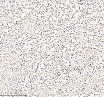 Immunohistochemical staining of Annexin using anti-Annexin antibody. Annexin was detected in a paraffin-embedded section of human testis cancer tissue. Heat mediated antigen retrieval was performed in EDTA buffer (pH 8.0, epitope retrieval solution). The tissue section was blocked with 10% goat serum. The tissue section was then incubated with 2 ug/ml rabbit anti-Annexin antibody overnight at 4oC. Peroxidase Conjugated Goat Anti-rabbit IgG was used as secondary antibody and incubated for 30 minutes at 37oC. The tissue section was developed using an HRP secondary and DAB substrate.