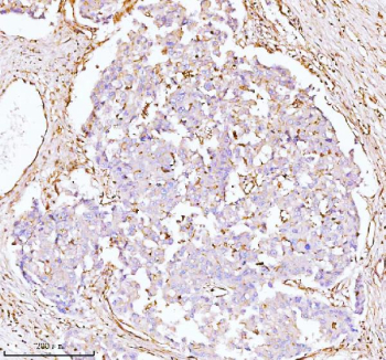 Immunohistochemical staining of GNAI2 using anti-GNAI2 antibody. GNAI2 was detected in a paraffin-embedded section of human liver cancer tissue. Heat mediated antigen retrieval was performed in EDTA buffer (pH 8.0, epitope retrieval solution). The tissue section was blocked with 10% goat serum. The tissue section was then incubated with 2 ug/ml rabbit anti-GNAI2 antibody overnight at 4oC. Peroxidase Conjugated Goat Anti-rabbit IgG was used as secondary antibody and incubated for 30 minutes at 37oC. The tissue section was developed using an HRP secondary and DAB substrate.