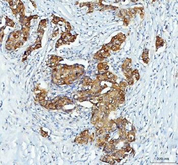 Immunohistochemical staining of DCTPP1 using anti-DCTPP1 antibody. DCTPP1 was detected in a paraffin-embedded section of human breast cancer tissue. Heat mediated antigen retrieval was performed in EDTA buffer (pH 8.0, epitope retrieval solution). The tissue section was blocked with 10% goat serum. The tissue section was then incubated with 2 ug/ml rabbit anti-DCTPP1 antibody overnight at 4oC. Peroxidase Conjugated Goat Anti-rabbit IgG was used as secondary antibody and incubated for 30 minutes at 37oC. The tissue section was developed using an HRP secondary and DAB substrate.