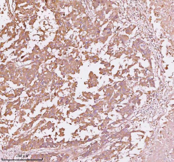 Immunohistochemical staining of TNS3 using anti-TNS3 antibody. TNS3 was detected in a paraffin-embedded section of human liver cancer tissue. Heat mediated antigen retrieval was performed in EDTA buffer (pH 8.0, epitope retrieval solution). The tissue section was blocked with 10% goat serum. The tissue section was then incubated with 2 ug/ml rabbit anti-TNS3 antibody overnight at 4oC. Peroxidase Conjugated Goat Anti-rabbit IgG was used as secondary antibody and incubated for 30 minutes at 37oC. The tissue section was developed using an HRP secondary and DAB substrate.