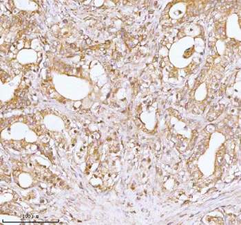 Immunohistochemical staining of TNS3 using anti-TNS3 antibody. TNS3 was detected in a paraffin-embedded section of human prostate adenocarcinoma tissue. Heat mediated antigen retrieval was performed in EDTA buffer (pH 8.0, epitope retrieval solution). The tissue section was blocked with 10% goat serum. The tissue section was then incubated with 2 ug/ml rabbit anti-TNS3 antibody overnight at 4oC. Peroxidase Conjugated Goat Anti-rabbit IgG was used as secondary antibody and incubated for 30 minutes at 37oC. The tissue section was developed using an HRP secondary and DAB substrate.