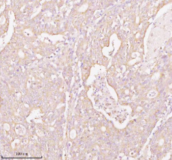 Immunohistochemical staining of TNS3 using anti-TNS3 antibody. TNS3 was detected in a paraffin-embedded section of human colon adenocarcinoma tissue. Heat mediated antigen retrieval was performed in EDTA buffer (pH 8.0, epitope retrieval solution). The tissue section was blocked with 10% goat serum. The tissue section was then incubated with 2 ug/ml rabbit anti-TNS3 antibody overnight at 4oC. Peroxidase Conjugated Goat Anti-rabbit IgG was used as secondary antibody and incubated for 30 minutes at 37oC. The tissue section was developed using an HRP secondary and DAB substrate.