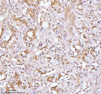 Immunohistochemical staining of RBM42 using anti-RBM42 antibody. RBM42 was detected in a paraffin-embedded section of human prostate adenocarcinoma tissue. Heat mediated antigen retrieval was performed in EDTA buffer (pH 8.0, epitope retrieval solution). The tissue section was blocked with 10% goat serum. The tissue section was then incubated with 2 ug/ml rabbit anti-RBM42 antibody overnight at 4oC. Peroxidase Conjugated Goat Anti-rabbit IgG was used as secondary antibody and incubated for 30 minutes at 37oC. The tissue section was developed using an HRP secondary and DAB substrate.