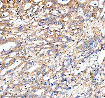 Immunohistochemical staining of FUNDC1 using anti-FUNDC1 antibody. FUNDC1 was detected in a paraffin-embedded section of human pancreas cancer tissue. Heat mediated antigen retrieval was performed in EDTA buffer (pH 8.0, epitope retrieval solution). The tissue section was blocked with 10% goat serum. The tissue section was then incubated with 2 ug/ml rabbit anti-FUNDC1 antibody overnight at 4oC. Peroxidase Conjugated Goat Anti-rabbit IgG was used as secondary antibody and incubated for 30 minutes at 37oC. The tissue section was developed using an HRP secondary and DAB substrate.