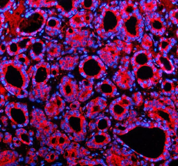 Immunofluorescent staining of SHE using anti-SHE antibody (red). SHE was detected in a paraffin-embedded section of human thyroid cancer tissue. Heat mediated antigen retrieval was performed in EDTA buffer (pH 8.0, epitope retrieval solution). The tissue section was blocked with 10% goat serum. The tissue section was then incubated with 5 ug/ml rabbit anti-SHE antibody overnight at 4oC. Cy3 Conjugated Goat Anti-Rabbit IgG was used as secondary antibody at 1:500 dilution and incubated for 30 minutes at 37oC. The section was counterstained with DAPI nuclear stain (blue). Visualize using a fluorescence microscope and filter sets appropriate for the label used.
