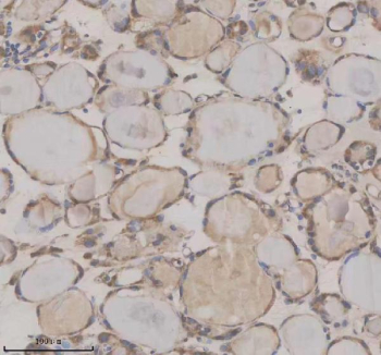 Immunohistochemical staining of SHE using anti-SHE antibody. SHE was detected in a paraffin-embedded section of human thyroid cancer tissue. Heat mediated antigen retrieval was performed in EDTA buffer (pH 8.0, epitope retrieval solution). The tissue section was blocked with 10% goat serum. The tissue section was then incubated with 2 ug/ml rabbit anti-SHE antibody overnight at 4oC. Peroxidase Conjugated Goat Anti-rabbit IgG was used as secondary antibody and incubated for 30 minutes at 37oC. The tissue section was developed using an HRP secondary and DAB substrate.