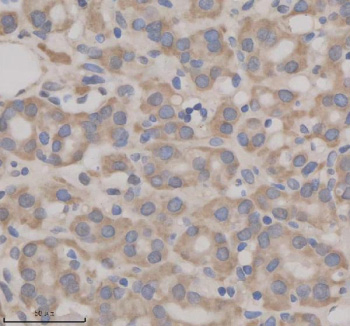 Immunohistochemical staining of SHE using anti-SHE antibody. SHE was detected in a paraffin-embedded section of human thyroid cancer tissue. Heat mediated antigen retrieval was performed in EDTA buffer (pH 8.0, epitope retrieval solution). The tissue section was blocked with 10% goat serum. The tissue section was then incubated with 2 ug/ml rabbit anti-SHE antibody overnight at 4oC. Peroxidase Conjugated Goat Anti-rabbit IgG was used as secondary antibody and incubated for 30 minutes at 37oC. The tissue section was developed using an HRP secondary and DAB substrate.