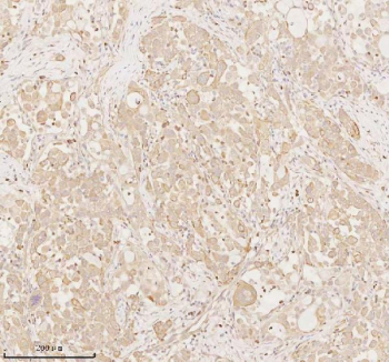 Immunohistochemical staining of ARHGEF7 using anti-ARHGEF7 antibody. ARHGEF7 was detected in a paraffin-embedded section of human lung adenocarcinoma tissue. Heat mediated antigen retrieval was performed in EDTA buffer (pH 8.0, epitope retrieval solution). The tissue section was blocked with 10% goat serum. The tissue section was then incubated with 2 ug/ml rabbit anti-ARHGEF7 antibody overnight at 4oC. Peroxidase Conjugated Goat Anti-rabbit IgG was used as secondary antibody and incubated for 30 minutes at 37oC. The tissue section was developed using an HRP secondary and DAB substrate.