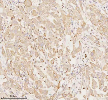 Immunohistochemical staining of ARHGEF7 using anti-ARHGEF7 antibody. ARHGEF7 was detected in a paraffin-embedded section of human lung adenocarcinoma tissue. Heat mediated antigen retrieval was performed in EDTA buffer (pH 8.0, epitope retrieval solution). The tissue section was blocked with 10% goat serum. The tissue section was then incubated with 2 ug/ml rabbit anti-ARHGEF7 antibody overnight at 4oC. Peroxidase Conjugated Goat Anti-rabbit IgG was used as secondary antibody and incubated for 30 minutes at 37oC. The tissue section was developed using an HRP secondary and DAB substrate.