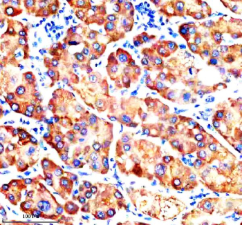 Immunohistochemical staining of SLC27A2 using anti-SLC27A2 antibody. SLC27A2 was detected in a paraffin-embedded section of human liver cancer tissue. Heat mediated antigen retrieval was performed in EDTA buffer (pH 8.0, epitope retrieval solution). The tissue section was blocked with 10% goat serum. The tissue section was then incubated with 2 ug/ml rabbit anti-SLC27A2 antibody overnight at 4oC. Peroxidase Conjugated Goat Anti-rabbit IgG was used as secondary antibody and incubated for 30 minutes at 37oC. The tissue section was developed using an HRP secondary and DAB substrate.