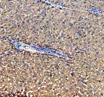 Immunohistochemical staining of ABCG5 using anti-ABCG5 antibody. ABCG5 was detected in a paraffin-embedded section of human liver cancer tissue. Heat mediated antigen retrieval was performed in EDTA buffer (pH 8.0, epitope retrieval solution). The tissue section was blocked with 10% goat serum. The tissue section was then incubated with 2 ug/ml rabbit anti-ABCG5 antibody overnight at 4oC. Peroxidase Conjugated Goat Anti-rabbit IgG was used as secondary antibody and incubated for 30 minutes at 37oC. The tissue section was developed using an HRP secondary and DAB substrate.