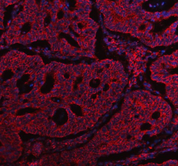 Immunofluorescent staining of ABCG5 using anti-ABCG5 antibody (red). ABCG5 was detected in a paraffin-embedded section of human colon cancer tissue. Heat mediated antigen retrieval was performed in EDTA buffer (pH 8.0, epitope retrieval solution). The tissue section was blocked with 10% goat serum. The tissue section was then incubated with 5 ug/ml rabbit anti-ABCG5 antibody overnight at 4oC. Cy3 Conjugated Goat Anti-Rabbit IgG was used as secondary antibody at 1:500 dilution and incubated for 30 minutes at 37oC. The section was counterstained with DAPI nuclear stain (blue). Visualize using a fluorescence microscope and filter sets appropriate for the label used.