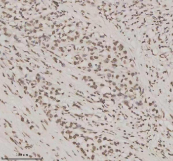 Immunohistochemical staining of NUPR1 using anti-NUPR1 antibody. NUPR1 was detected in a paraffin-embedded section of human lung cancer tissue. Heat mediated antigen retrieval was performed in EDTA buffer (pH 8.0, epitope retrieval solution). The tissue section was blocked with 10% goat serum. The tissue section was then incubated with 2 ug/ml rabbit anti-NUPR1 antibody overnight at 4oC. Peroxidase Conjugated Goat Anti-rabbit IgG was used as secondary antibody and incubated for 30 minutes at 37oC. The tissue section was developed using an HRP secondary and DAB substrate.