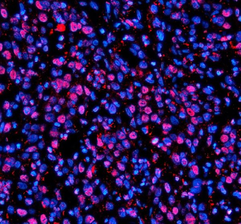 Immunofluorescent staining of NUPR1 using anti-NUPR1 antibody (red). NUPR1 was detected in a paraffin-embedded section of human bladder cancer tissue. Heat mediated antigen retrieval was performed in EDTA buffer (pH 8.0, epitope retrieval solution). The tissue section was blocked with 10% goat serum. The tissue section was then incubated with 5 ug/ml rabbit anti-NUPR1 antibody overnight at 4oC. Cy3 Conjugated Goat Anti-Rabbit IgG was used as secondary antibody at 1:500 dilution and incubated for 30 minutes at 37oC. The section was counterstained with DAPI nuclear stain (blue). Visualize using a fluorescence microscope and filter sets appropriate for the label used.