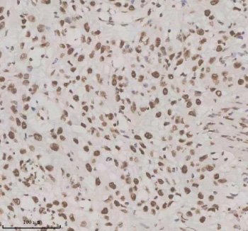 Immunohistochemical staining of NUPR1 using anti-NUPR1 antibody. NUPR1 was detected in a paraffin-embedded section of human bladder cancer tissue. Heat mediated antigen retrieval was performed in EDTA buffer (pH 8.0, epitope retrieval solution). The tissue section was blocked with 10% goat serum. The tissue section was then incubated with 2 ug/ml rabbit anti-NUPR1 antibody overnight at 4oC. Peroxidase Conjugated Goat Anti-rabbit IgG was used as secondary antibody and incubated for 30 minutes at 37oC. The tissue section was developed using an HRP secondary and DAB substrate.