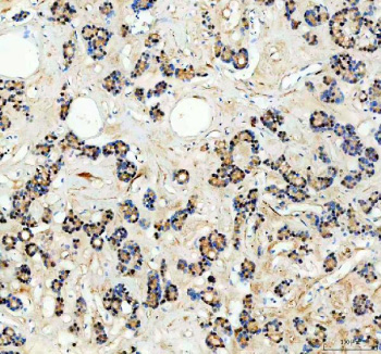 Immunohistochemical staining of SPOPL using anti-SPOPL antibody. SPOPL was detected in a paraffin-embedded section of human thyroid cancer tissue. Heat mediated antigen retrieval was performed in EDTA buffer (pH 8.0, epitope retrieval solution). The tissue section was blocked with 10% goat serum. The tissue section was then incubated with 2 ug/ml rabbit anti-SPOPL antibody overnight at 4oC. Peroxidase Conjugated Goat Anti-rabbit IgG was used as secondary antibody and incubated for 30 minutes at 37oC. The tissue section was developed using an HRP secondary and DAB substrate.