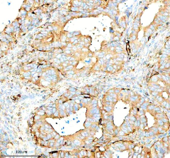 Immunohistochemical staining of SERPING1/C1 using anti-C1 Inhibitor (C1-INH) antibody. SERPING1/C1 was detected in a paraffin-embedded section of human ovarian cancer tissue. Heat mediated antigen retrieval was performed in EDTA buffer (pH 8.0, epitope retrieval solution). The tissue section was blocked with 10% goat serum. The tissue section was then incubated with 1:100 rabbit anti-C1 Inhibitor (C1-INH) antibody overnight at 4oC. Peroxidase Conjugated Goat Anti-rabbit IgG was used as secondary antibody and incubated for 30 minutes at 37oC. The tissue section was developed using an HRP secondary and DAB substrate.