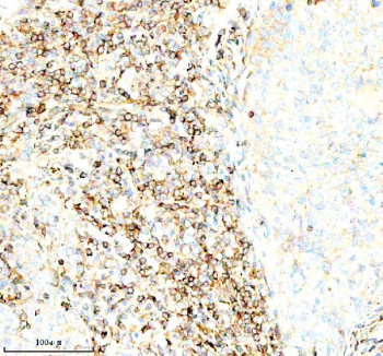 Immunohistochemical staining of SERPING1/C1 using anti-C1 Inhibitor (C1-INH) antibody. SERPING1/C1 was detected in a paraffin-embedded section of human cervical cancer tissue. Heat mediated antigen retrieval was performed in EDTA buffer (pH 8.0, epitope retrieval solution). The tissue section was blocked with 10% goat serum. The tissue section was then incubated with 1:100 rabbit anti-C1 Inhibitor (C1-INH) antibody overnight at 4oC. Peroxidase Conjugated Goat Anti-rabbit IgG was used as secondary antibody and incubated for 30 minutes at 37oC. The tissue section was developed using an HRP secondary and DAB substrate.