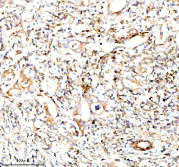 Immunohistochemical staining of SERPING1/C1 using anti-C1 Inhibitor (C1-INH) antibody. SERPING1/C1 was detected in a paraffin-embedded section of human rectal cancer tissue. Heat mediated antigen retrieval was performed in EDTA buffer (pH 8.0, epitope retrieval solution). The tissue section was blocked with 10% goat serum. The tissue section was then incubated with 1:100 rabbit anti-C1 Inhibitor (C1-INH) antibody overnight at 4oC. Peroxidase Conjugated Goat Anti-rabbit IgG was used as secondary antibody and incubated for 30 minutes at 37oC. The tissue section was developed using an HRP secondary and DAB substrate.