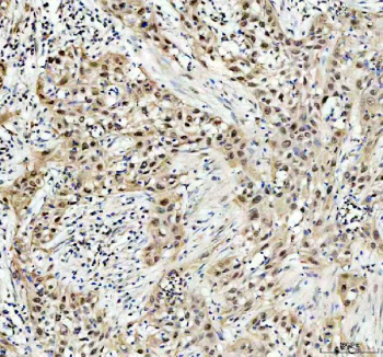 Immunohistochemical staining of POLD1 using anti-POLD1 antibody. POLD1 was detected in a paraffin-embedded section of human bladder cancer tissue. Heat mediated antigen retrieval was performed in EDTA buffer (pH 8.0, epitope retrieval solution). The tissue section was blocked with 10% goat serum. The tissue section was then incubated with 2 ug/ml rabbit anti-POLD1 antibody overnight at 4oC. Peroxidase Conjugated Goat Anti-rabbit IgG was used as secondary antibody and incubated for 30 minutes at 37oC. The tissue section was developed using an HRP secondary and DAB substrate.