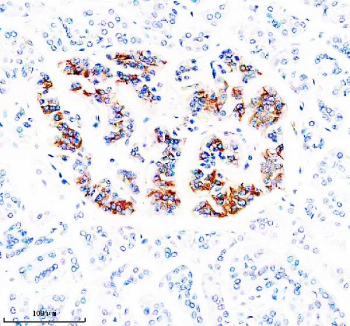 Immunohistochemical staining of ZNT8/SLC30A using anti-SLC30A antibody. ZNT8/SLC30A was detected in a paraffin-embedded section of human pancreas tissue. Heat mediated antigen retrieval was performed in EDTA buffer (pH 8.0, epitope retrieval solution). The tissue section was blocked with 10% goat serum. The tissue section was then incubated with 2 ug/ml rabbit anti-SLC30A antibody overnight at 4oC. Peroxidase Conjugated Goat Anti-rabbit IgG was used as secondary antibody and incubated for 30 minutes at 37oC. The tissue section was developed using an HRP secondary and DAB substrate.