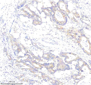 Immunohistochemical staining of PLS1 using anti-PLS1 antibody. PLS1 was detected in a paraffin-embedded section of human colon cancer tissue. Heat mediated antigen retrieval was performed in EDTA buffer (pH 8.0, epitope retrieval solution). The tissue section was blocked with 10% goat serum. The tissue section was then incubated with 2 ug/ml rabbit anti-PLS1 antibody overnight at 4oC. Peroxidase Conjugated Goat Anti-rabbit IgG was used as secondary antibody and incubated for 30 minutes at 37oC. The tissue section was developed using an HRP secondary and DAB substrate.