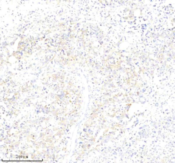 Immunohistochemical staining of PLS1 using anti-PLS1 antibody. PLS1 was detected in a paraffin-embedded section of human stomach cancer tissue. Heat mediated antigen retrieval was performed in EDTA buffer (pH 8.0, epitope retrieval solution). The tissue section was blocked with 10% goat serum. The tissue section was then incubated with 2 ug/ml rabbit anti-PLS1 antibody overnight at 4oC. Peroxidase Conjugated Goat Anti-rabbit IgG was used as secondary antibody and incubated for 30 minutes at 37oC. The tissue section was developed using an HRP secondary and DAB substrate.