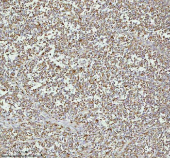 Immunohistochemical staining of MELTF using anti-MELTF antibody. MELTF was detected in a paraffin-embedded section of human melanoma cancer tissue. Heat mediated antigen retrieval was performed in EDTA buffer (pH 8.0, epitope retrieval solution). The tissue section was blocked with 10% goat serum. The tissue section was then incubated with 2 ug/ml rabbit anti-MELTF antibody overnight at 4oC. Peroxidase Conjugated Goat Anti-rabbit IgG was used as secondary antibody and incubated for 30 minutes at 37oC. The tissue section was developed using an HRP secondary and DAB substrate.