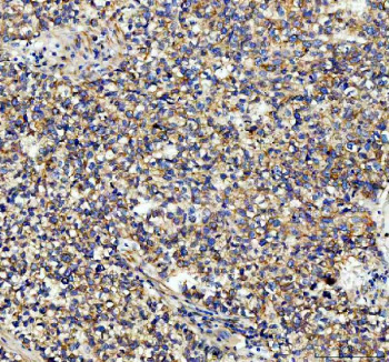 Immunohistochemical staining of Tubulin Alpha using anti-Alpha Tubulin antibody. Tubulin Alpha was detected in a paraffin-embedded section of human lung cancer tissue. Heat mediated antigen retrieval was performed in EDTA buffer (pH 8.0, epitope retrieval solution). The tissue section was blocked with 10% goat serum. The tissue section was then incubated with 2 ug/ml rabbit anti-Alpha Tubulin antibody overnight at 4oC. Peroxidase Conjugated Goat Anti-rabbit IgG was used as secondary antibody and incubated for 30 minutes at 37oC. The tissue section was developed using an HRP secondary and DAB substrate.