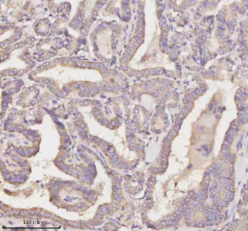 Immunohistochemical staining of MEST using anti-MEST antibody. MEST was detected in a paraffin-embedded section of human thyroid papillary carcinoma tissue. Heat mediated antigen retrieval was performed in EDTA buffer (pH 8.0, epitope retrieval solution). The tissue section was blocked with 10% goat serum. The tissue section was then incubated with 2 ug/ml rabbit anti-MEST antibody overnight at 4oC. Peroxidase Conjugated Goat Anti-rabbit IgG was used as secondary antibody and incubated for 30 minutes at 37oC. The tissue section was developed using an HRP secondary and DAB substrate.