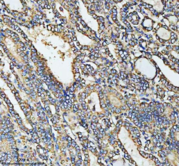 Immunohistochemical staining of HADHA using anti-HADHA antibody. HADHA was detected in a paraffin-embedded section of human thyroid papillary carcinoma tissue. Heat mediated antigen retrieval was performed in EDTA buffer (pH 8.0, epitope retrieval solution). The tissue section was blocked with 10% goat serum. The tissue section was then incubated with 2 ug/ml rabbit anti-HADHA antibody overnight at 4oC. Peroxidase Conjugated Goat Anti-rabbit IgG was used as secondary antibody and incubated for 30 minutes at 37oC. The tissue section was developed using an HRP secondary and DAB substrate.