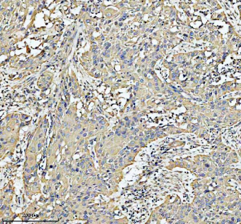 Immunohistochemical staining of HADHA using anti-HADHA antibody. HADHA was detected in a paraffin-embedded section of human bladder cancer tissue. Heat mediated antigen retrieval was performed in EDTA buffer (pH 8.0, epitope retrieval solution). The tissue section was blocked with 10% goat serum. The tissue section was then incubated with 2 ug/ml rabbit anti-HADHA antibody overnight at 4oC. Peroxidase Conjugated Goat Anti-rabbit IgG was used as secondary antibody and incubated for 30 minutes at 37oC. The tissue section was developed using an HRP secondary and DAB substrate.