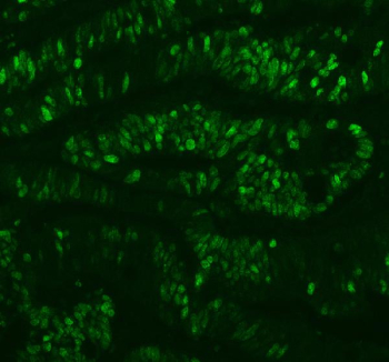 Ki-67 Antibody Clone 31K02 / MKI67 Antibody Clone 31K02. Immunofluorescence analysis of paraffin-embedded human intestinal carcinoma tissue using Ki-67 antibody clone 31K02. Strong nuclear fluorescence (green) is observed in numerous proliferating tumor epithelial cells, consistent with the known nuclear localization of Ki-67 / MKI67 during active phases of the cell cycle. Non-proliferating surrounding cells show reduced fluorescence signal. Heat-induced antigen retrieval was performed in EDTA buffer (pH 8.0) prior to staining. The tissue section was incubated with Ki-67 antibody clone 31K02 followed by DyLight 488 conjugated goat anti-rabbit IgG secondary antibody, and fluorescence signal was visualized using appropriate fluorescence microscopy filter sets.