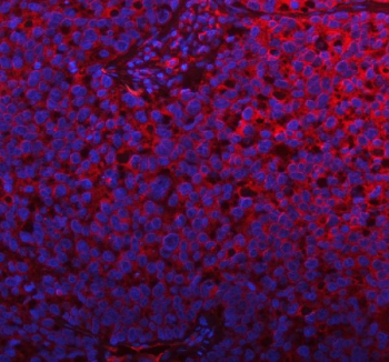 Immunofluorescent staining of FFPE human lung cancer tissue with PLBD2 antibody (red) and DAPI nuclear stain (blue). HIER: steam section in pH8 EDTA buffer for 20 min.