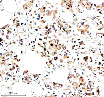 Immunohistochemical staining of NR1D1 using anti-NR1D1 antibody. NR1D1 was detected in a paraffin-embedded section of human breast cancer tissue. Heat mediated antigen retrieval was performed in EDTA buffer (pH 8.0, epitope retrieval solution). The tissue section was blocked with 10% goat serum. The tissue section was then incubated with 2 ug/ml rabbit anti-NR1D1 antibody overnight at 4oC. Peroxidase Conjugated Goat Anti-rabbit IgG was used as secondary antibody and incubated for 30 minutes at 37oC. The tissue section was developed using an HRP secondary and DAB substrate.