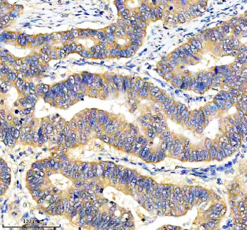 Immunohistochemical staining of DEPDC6/DEPTOR using anti-DEPTOR antibody. DEPDC6/DEPTOR was detected in a paraffin-embedded section of human stomach cancer tissue. Heat mediated antigen retrieval was performed in EDTA buffer (pH 8.0, epitope retrieval solution). The tissue section was blocked with 10% goat serum. The tissue section was then incubated with 2 ug/ml rabbit anti-DEPTOR antibody overnight at 4oC. Peroxidase Conjugated Goat Anti-rabbit IgG was used as secondary antibody and incubated for 30 minutes at 37oC. The tissue section was developed using an HRP secondary and DAB substrate.