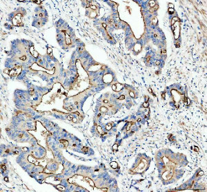 GPRC5A Antibody Human Colon Cancer IHC. Immunohistochemistry analysis of FFPE human colon cancer tissue using GPRC5A Antibody. Heat induced antigen retrieval was performed in pH 8.0 EDTA buffer prior to overnight incubation with primary antibody (2 ug/mL) at 4Â°C. Peroxidase-conjugated goat anti-rabbit IgG and DAB chromogen were used for visualization. Predominantly membranous staining is observed in malignant epithelial cells, consistent with the localization of GPRC5A as a retinoic acid-inducible orphan G protein-coupled receptor. These results support the use of GPRC5A Antibody / Retinoic Acid Inducible GPCR Antibody for studying GPRC5A expression, epithelial GPCR biology and cancer-associated signaling.