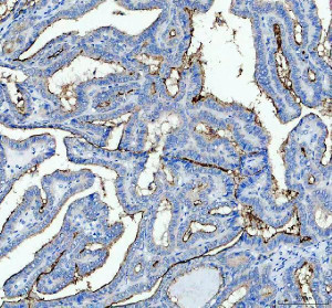 GPRC5A Antibody Human Thyroid Cancer IHC. Immunohistochemistry analysis of FFPE human thyroid cancer tissue using GPRC5A Antibody. Heat induced antigen retrieval was performed in pH 8.0 EDTA buffer prior to overnight incubation with primary antibody (2 ug/mL) at 4Â°C. Peroxidase-conjugated goat anti-rabbit IgG and DAB chromogen were used for visualization. Predominantly membranous staining is observed in malignant epithelial cells, consistent with the localization of GPRC5A as a retinoic acid-inducible orphan G protein-coupled receptor expressed in epithelial tissues. These results support the use of GPRC5A Antibody / Retinoic Acid Inducible GPCR Antibody for studying GPRC5A expression, epithelial GPCR biology and cancer-associated signaling.