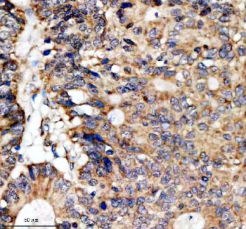 Immunohistochemical staining of SFXN4 using anti-SFXN4 antibody. SFXN4 was detected in a paraffin-embedded section of human colon cancer tissue. Heat mediated antigen retrieval was performed in EDTA buffer (pH 8.0, epitope retrieval solution). The tissue section was blocked with 10% goat serum. The tissue section was then incubated with 2 ug/ml rabbit anti-SFXN4 antibody overnight at 4oC. Peroxidase Conjugated Goat Anti-rabbit IgG was used as secondary antibody and incubated for 30 minutes at 37oC. The tissue section was developed using an HRP secondary and DAB substrate.