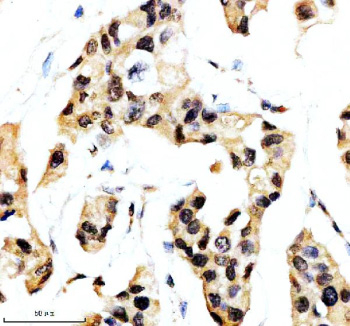 Immunohistochemical staining of SON using anti-SON antibody. SON was detected in a paraffin-embedded section of human breast cancer tissue. Heat mediated antigen retrieval was performed in EDTA buffer (pH 8.0, epitope retrieval solution). The tissue section was blocked with 10% goat serum. The tissue section was then incubated with 2 ug/ml rabbit anti-SON antibody overnight at 4oC. Peroxidase Conjugated Goat Anti-rabbit IgG was used as secondary antibody and incubated for 30 minutes at 37oC. The tissue section was developed using an HRP secondary and DAB substrate.