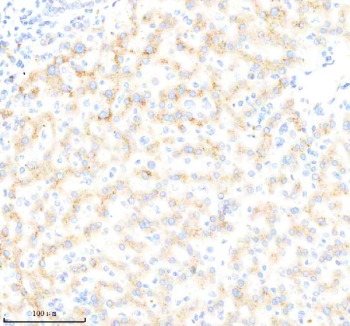 Immunohistochemical staining of BDKRB2 using anti-BDKRB2 antibody. BDKRB2 was detected in a paraffin-embedded section of human liver cancer tissue. Heat mediated antigen retrieval was performed in EDTA buffer (pH 8.0, epitope retrieval solution). The tissue section was blocked with 10% goat serum. The tissue section was then incubated with 1:200 rabbit anti-BDKRB2 antibody overnight at 4oC. Peroxidase Conjugated Goat Anti-rabbit IgG was used as secondary antibody and incubated for 30 minutes at 37oC. The tissue section was developed using an HRP secondary and DAB substrate.