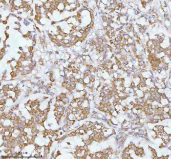 Immunohistochemical staining of SOAT1 using anti-SOAT1 antibody. SOAT1 was detected in a paraffin-embedded section of human breast cancer tissue. Heat mediated antigen retrieval was performed in EDTA buffer (pH 8.0, epitope retrieval solution). The tissue section was blocked with 10% goat serum. The tissue section was then incubated with 2 ug/ml rabbit anti-SOAT1 antibody overnight at 4oC. Peroxidase Conjugated Goat Anti-rabbit IgG was used as secondary antibody and incubated for 30 minutes at 37oC. The tissue section was developed using an HRP secondary and DAB substrate.