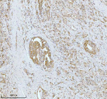 Immunohistochemical staining of SOAT1 using anti-SOAT1 antibody. SOAT1 was detected in a paraffin-embedded section of human prostatic cancer tissue. Heat mediated antigen retrieval was performed in EDTA buffer (pH 8.0, epitope retrieval solution). The tissue section was blocked with 10% goat serum. The tissue section was then incubated with 2 ug/ml rabbit anti-SOAT1 antibody overnight at 4oC. Peroxidase Conjugated Goat Anti-rabbit IgG was used as secondary antibody and incubated for 30 minutes at 37oC. The tissue section was developed using an HRP secondary and DAB substrate.