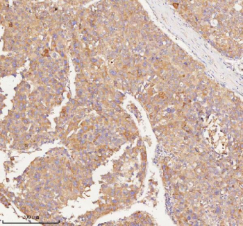 Immunohistochemical staining of RNF25 using anti-RNF25 antibody. RNF25 was detected in a paraffin-embedded section of human liver cancer tissue. Heat mediated antigen retrieval was performed in EDTA buffer (pH 8.0, epitope retrieval solution). The tissue section was blocked with 10% goat serum. The tissue section was then incubated with 2 ug/ml rabbit anti-RNF25 antibody overnight at 4oC. Peroxidase Conjugated Goat Anti-rabbit IgG was used as secondary antibody and incubated for 30 minutes at 37oC. The tissue section was developed using an HRP secondary and DAB substrate.
