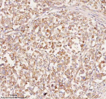 Immunohistochemical staining of RNF25 using anti-RNF25 antibody. RNF25 was detected in a paraffin-embedded section of human lung adenocarcinoma tissue. Heat mediated antigen retrieval was performed in EDTA buffer (pH 8.0, epitope retrieval solution). The tissue section was blocked with 10% goat serum. The tissue section was then incubated with 2 ug/ml rabbit anti-RNF25 antibody overnight at 4oC. Peroxidase Conjugated Goat Anti-rabbit IgG was used as secondary antibody and incubated for 30 minutes at 37oC. The tissue section was developed using an HRP secondary and DAB substrate.