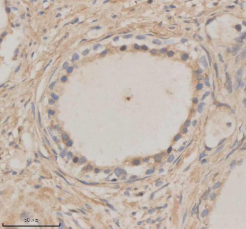 Immunohistochemical staining of MTMR3 using anti-MTMR3 antibody. MTMR3 was detected in a paraffin-embedded section of human prostate cancer tissue. Heat mediated antigen retrieval was performed in EDTA buffer (pH 8.0, epitope retrieval solution). The tissue section was blocked with 10% goat serum. The tissue section was then incubated with 2 ug/ml rabbit anti-MTMR3 antibody overnight at 4oC. Peroxidase Conjugated Goat Anti-rabbit IgG was used as secondary antibody and incubated for 30 minutes at 37oC. The tissue section was developed using an HRP secondary and DAB substrate.