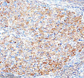 Immunohistochemical staining of ADAM12 using anti-ADAM12 antibody. ADAM12 was detected in a paraffin-embedded section of rat ovary tissue. Heat mediated antigen retrieval was performed in EDTA buffer (pH 8.0, epitope retrieval solution). The tissue section was blocked with 10% goat serum. The tissue section was then incubated with 1:100 rabbit anti-ADAM12 antibody overnight at 4oC. Peroxidase Conjugated Goat Anti-rabbit IgG was used as secondary antibody and incubated for 30 minutes at 37oC. The tissue section was developed using an HRP secondary and DAB substrate.