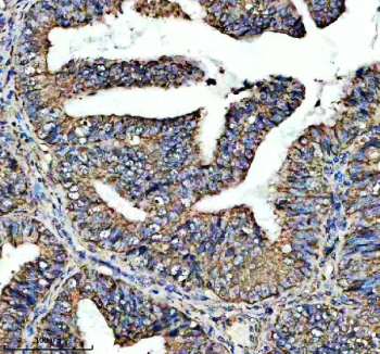 Immunohistochemical staining of ADAM12 using anti-ADAM12 antibody. ADAM12 was detected in a paraffin-embedded section of human endometrial cancer tissue. Heat mediated antigen retrieval was performed in EDTA buffer (pH 8.0, epitope retrieval solution). The tissue section was blocked with 10% goat serum. The tissue section was then incubated with 2 ug/ml rabbit anti-ADAM12 antibody overnight at 4oC. Peroxidase Conjugated Goat Anti-rabbit IgG was used as secondary antibody and incubated for 30 minutes at 37oC. The tissue section was developed using an HRP secondary and DAB substrate.
