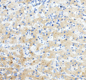 Immunohistochemical staining of PIP5K1A using anti-PIP5K1A antibody. PIP5K1A was detected in a paraffin-embedded section of human liver tissue. Heat mediated antigen retrieval was performed in EDTA buffer (pH 8.0, epitope retrieval solution). The tissue section was blocked with 10% goat serum. The tissue section was then incubated with 2 ug/ml rabbit anti-PIP5K1A antibody overnight at 4oC. Peroxidase Conjugated Goat Anti-rabbit IgG was used as secondary antibody and incubated for 30 minutes at 37oC. The tissue section was developed using an HRP secondary and DAB substrate.